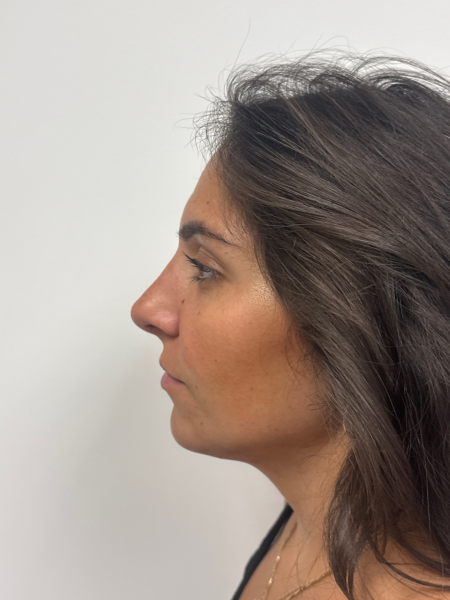 After Image: Rhinoplasty - left-side