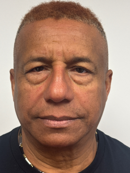 Before Image: Blepharoplasty - front