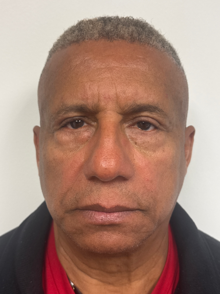 After Image: Blepharoplasty - front