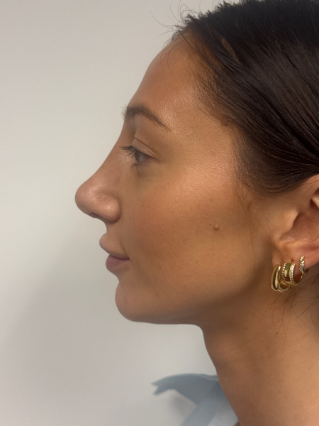 After Image: Rhinoplasty - left-side