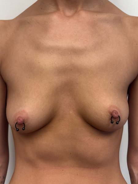 Before Image: Breast Augmentation - front