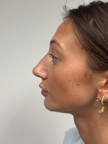 Before Image: Rhinoplasty - left-side