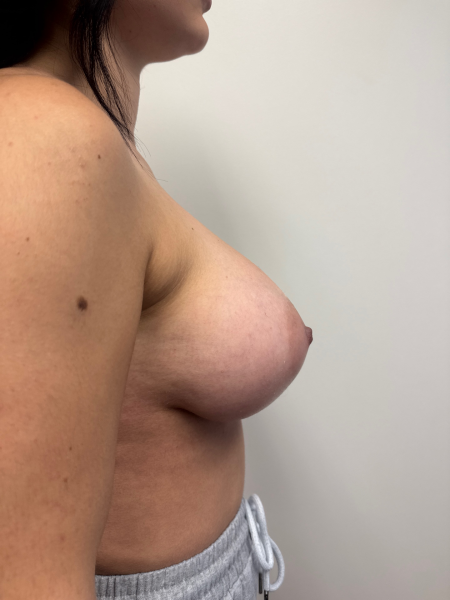After Image: Breast Augmentation - back