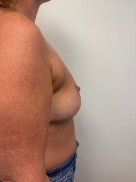 After Image: Breast Reduction - right-side