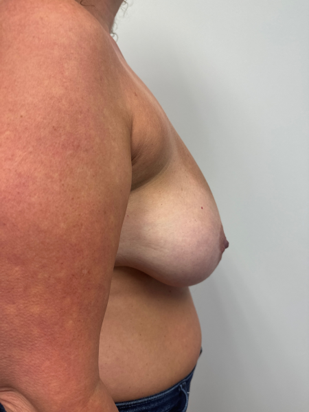 Before Image: Breast Reduction - right-side