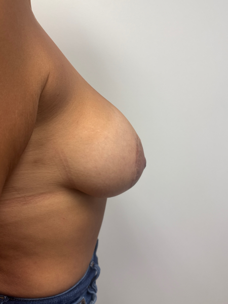 After Image: Breast Lift - right-side