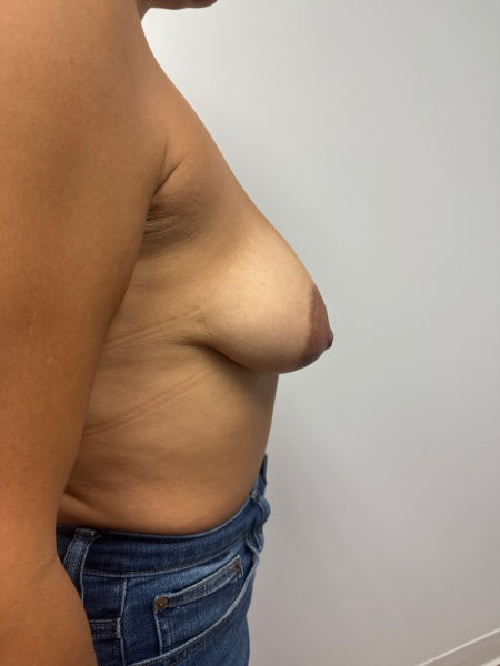 Before Image: Breast Lift - right-side