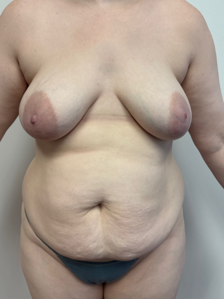 Before Image: Mommy Makeover - front