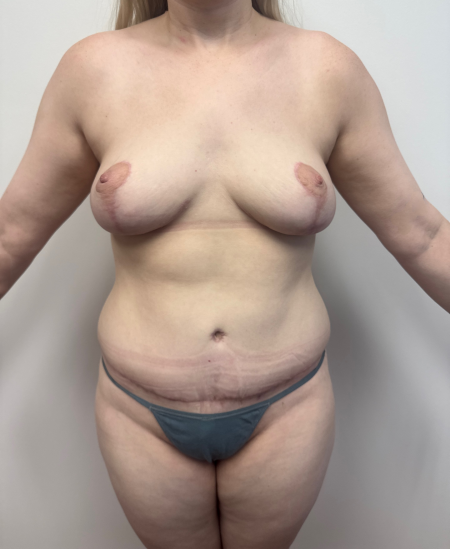 After Image: Mommy Makeover - front