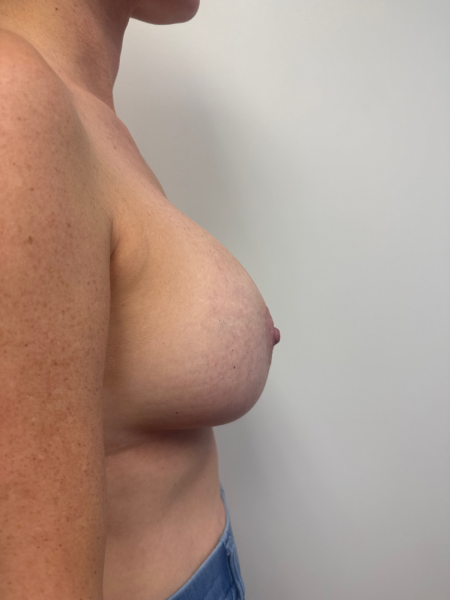 After Image: Breast Augmentation - right-side