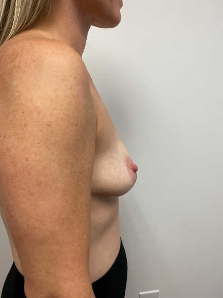Before Image: Breast Augmentation - right-side