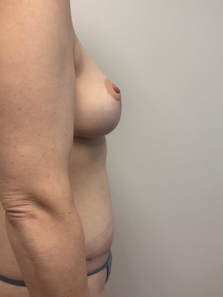 After Image: Mommy Makeover - right-side