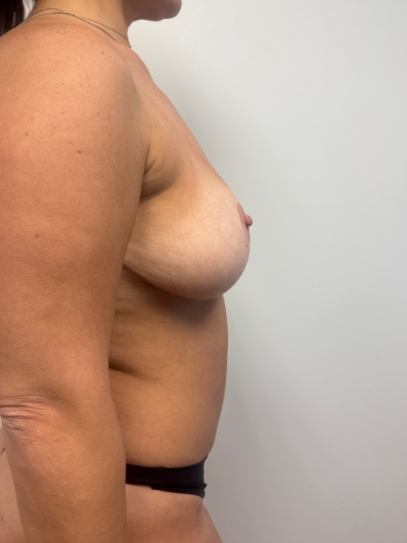 After Image: Mommy Makeover - back