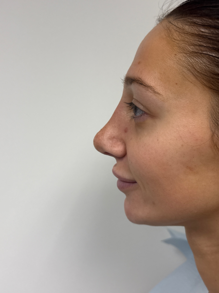 After Image: Rhinoplasty - left-side
