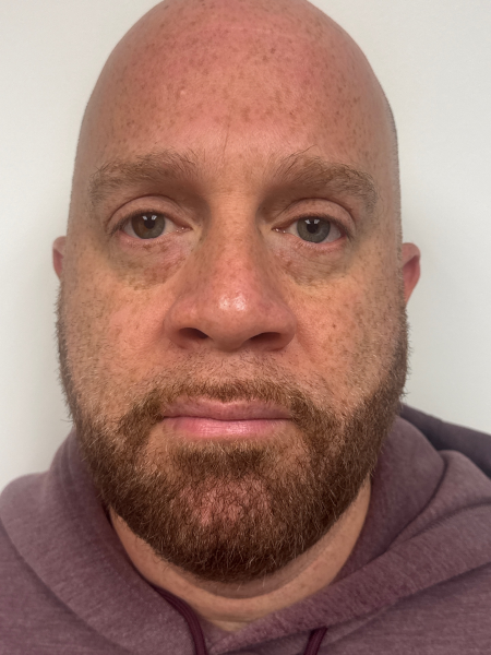 After Image: Blepharoplasty - front