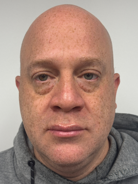 Before Image: Blepharoplasty - front