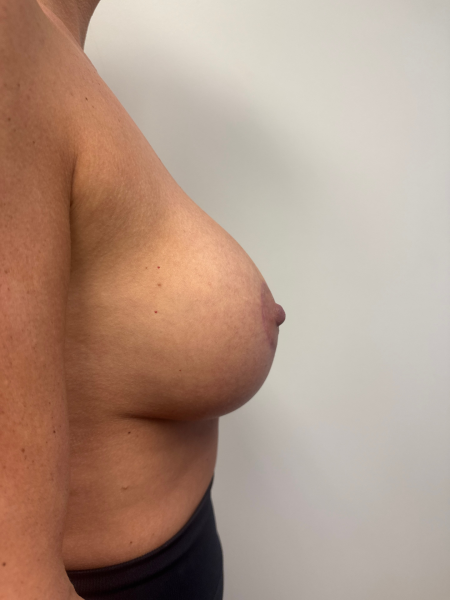 After Image: Breast Lift - right-side