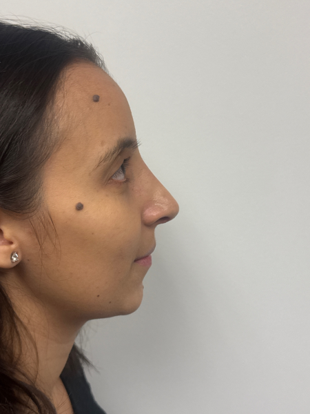 After Image: Rhinoplasty - right-side