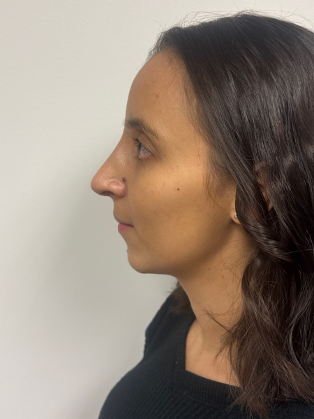 After Image: Rhinoplasty - left-side