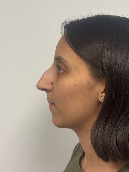 Before Image: Rhinoplasty - left-side