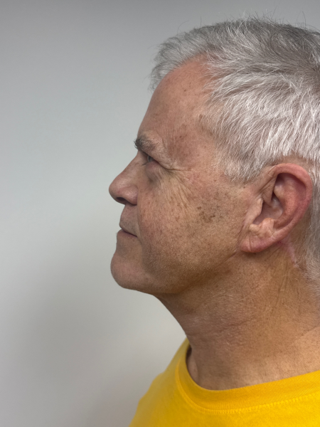 After Image: Neck Lift - front
