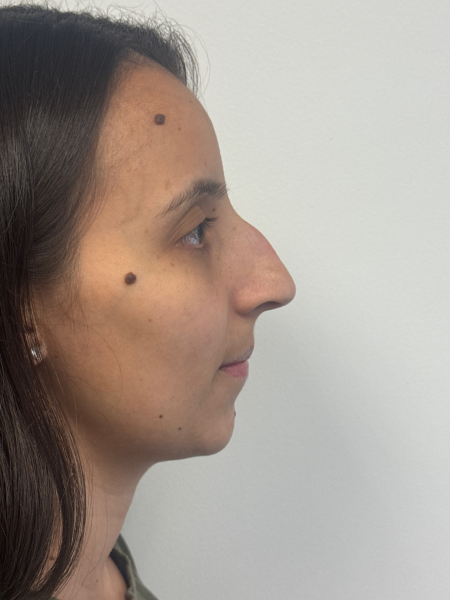 Before Image: Rhinoplasty - right-side