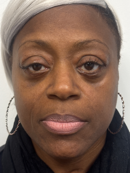 After Image: Blepharoplasty - front