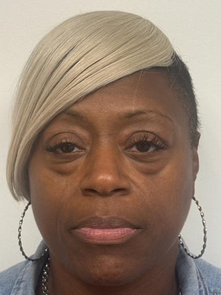 Before Image: Blepharoplasty - front