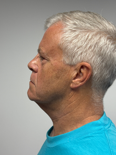Before Image: Neck Lift - front