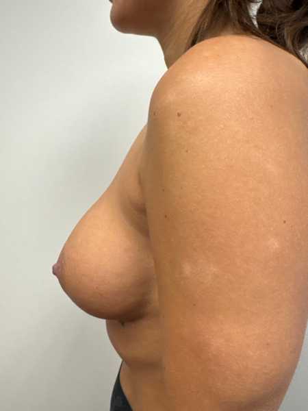 After Image: Breast Augmentation - back