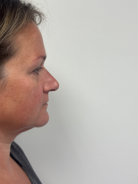 Before Image: Rhinoplasty - right-side