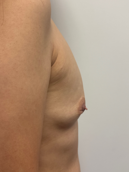 Before Image: Breast Augmentation - right-side