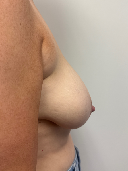 Before Image: Breast Reduction - back