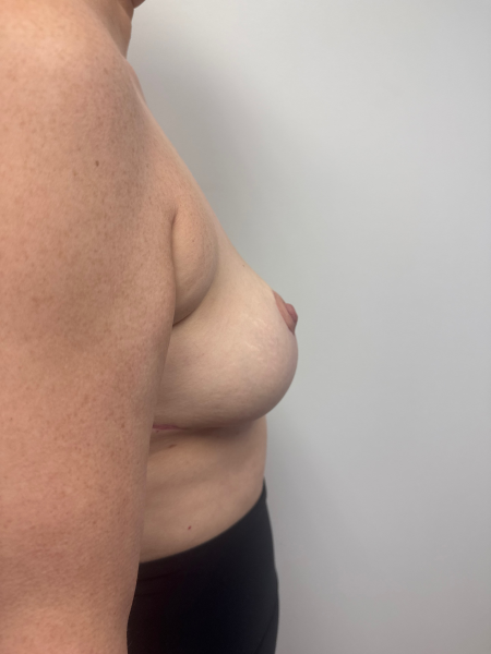 After Image: Breast Reduction - back