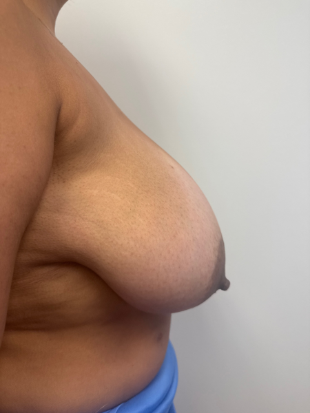 Before Image: Breast Reduction - back