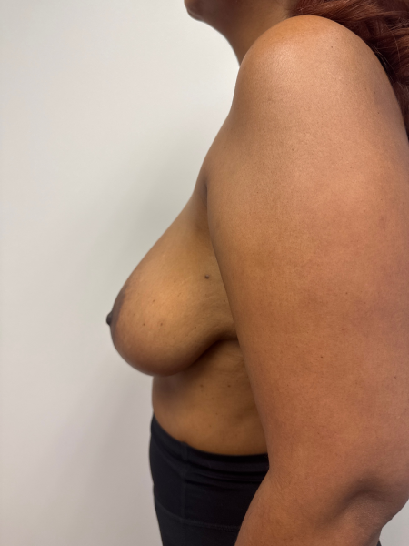 Before Image: Breast Reduction - back