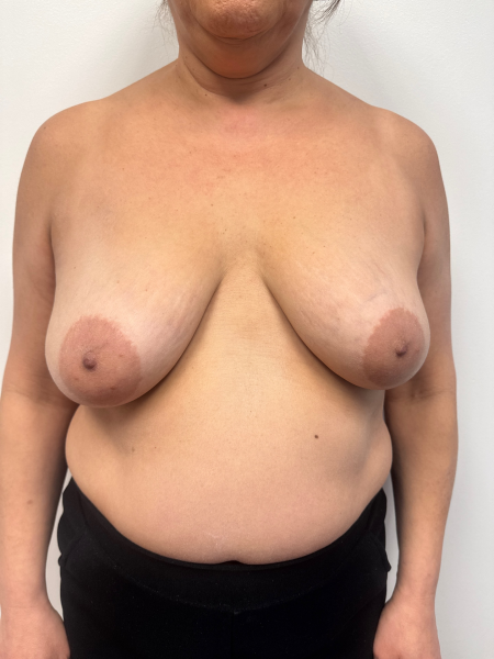 Before Image: Breast Lift - front