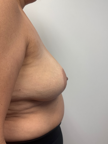 Before Image: Breast Lift - back