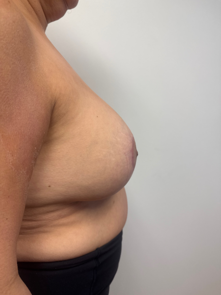 After Image: Breast Lift - back