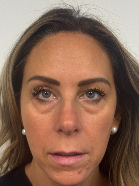 Before Image: Blepharoplasty - front