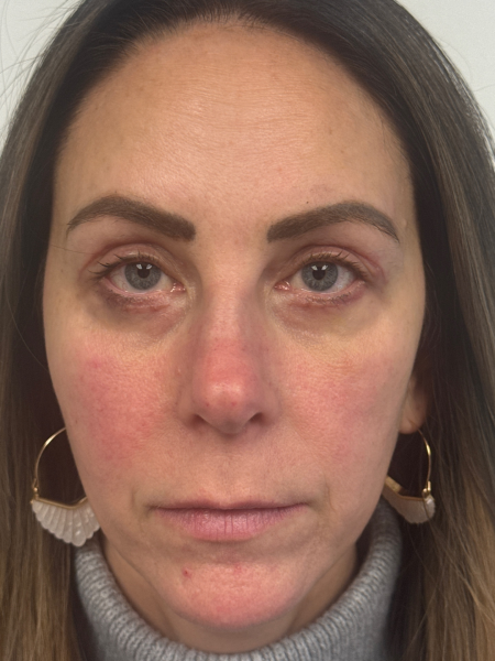 After Image: Blepharoplasty - front