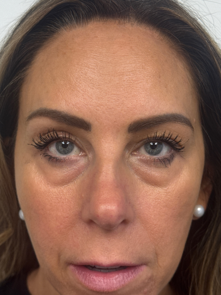 Before Image: Blepharoplasty - front