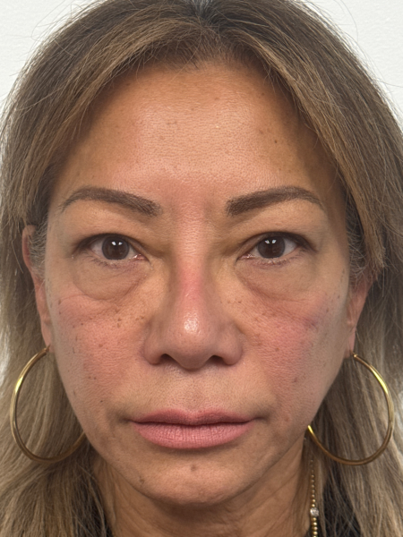 Before Image: Blepharoplasty - front