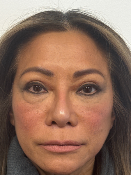 After Image: Blepharoplasty - front