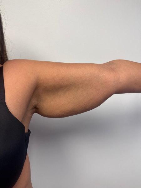 Before Image: After Weight Loss - back