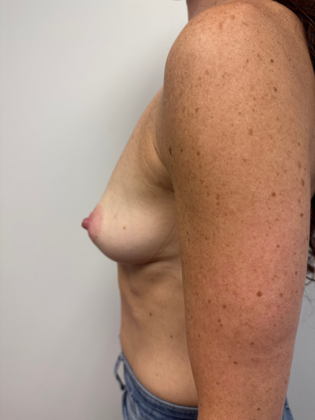 Before Image: Breast Augmentation - back