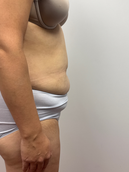 Before Image: Abdominoplasty - front