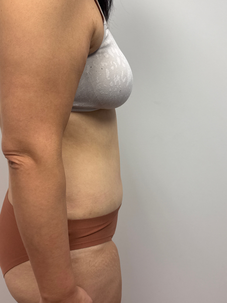 After Image: Abdominoplasty - front