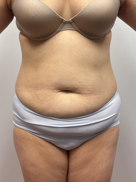 Before Image: Abdominoplasty - back