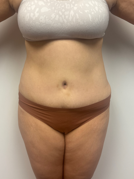 After Image: Abdominoplasty - back
